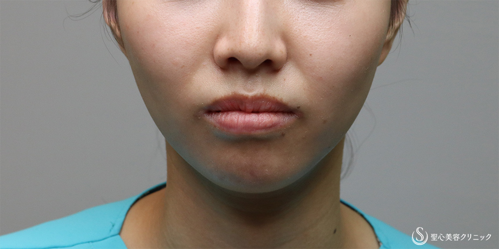 【30代女性・法令線を目立たなく】プレミアムPRP皮膚再生療法(6ヶ月後) Before 