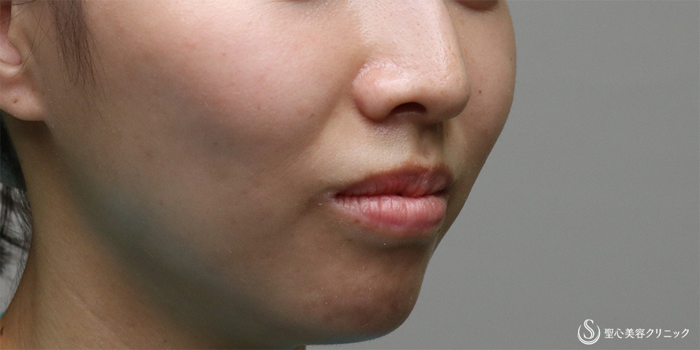 【30代女性・法令線を目立たなく】プレミアムPRP皮膚再生療法(6ヶ月後) Before 