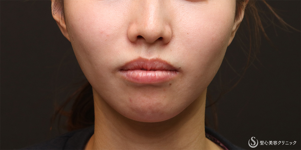 【30代女性・法令線を目立たなく】プレミアムPRP皮膚再生療法(6ヶ月後) After 