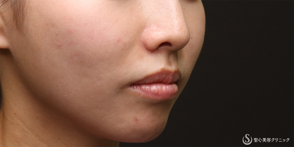 【30代女性・法令線を目立たなく】プレミアムPRP皮膚再生療法(6ヶ月後) After 