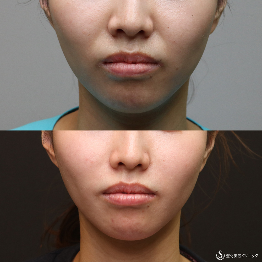 【30代女性・法令線を目立たなく】プレミアムPRP皮膚再生療法(6ヶ月後) After 