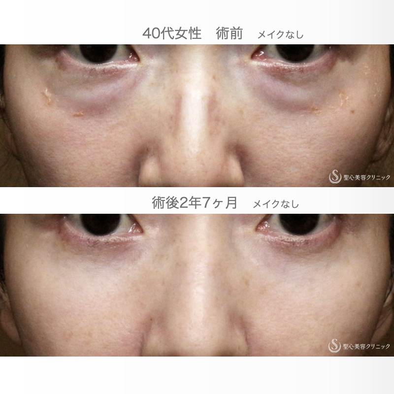 【40代女性・目の下のクマを切らずに解消】経結膜下脱脂術 単独（2年7ヶ月後） After 