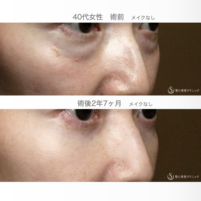 【40代女性・目の下のクマを切らずに解消】経結膜下脱脂術 単独（2年7ヶ月後） After 