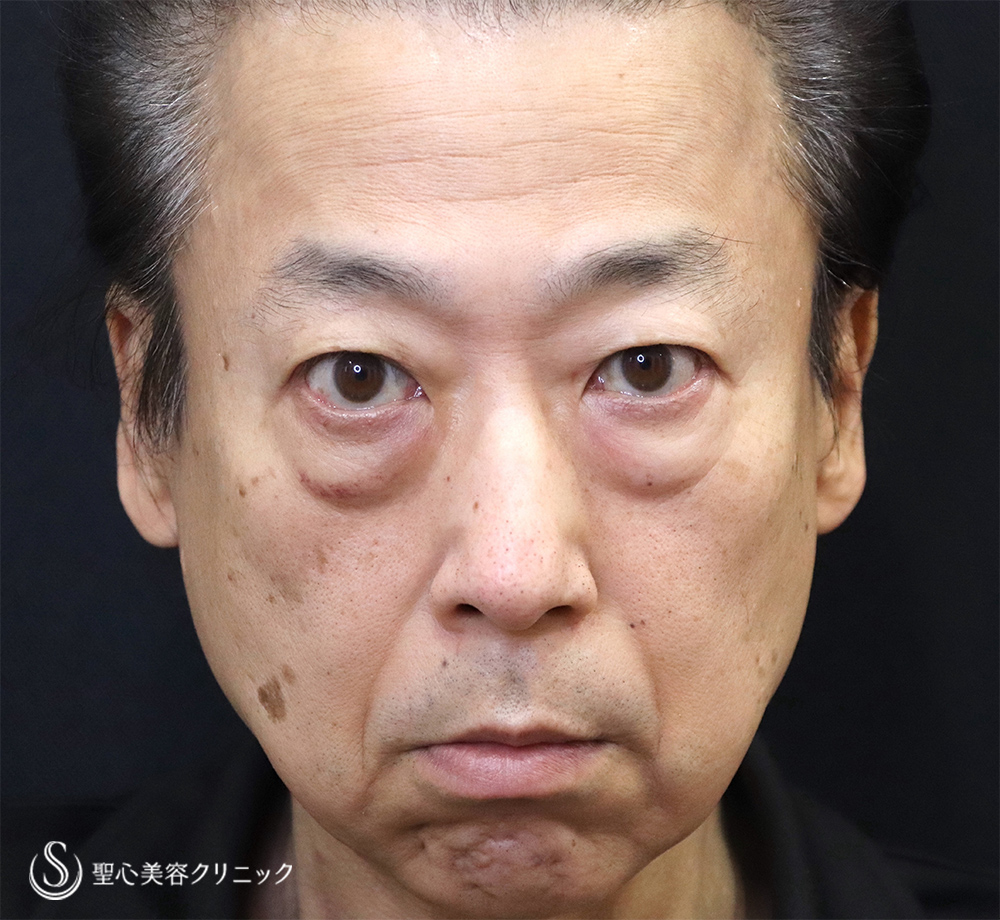 【60代男性・目の下のたるみ、ほうれい線】　目の下のたるみ取り＋プレミアムPRP皮膚再生療法（2か月半後） Before 