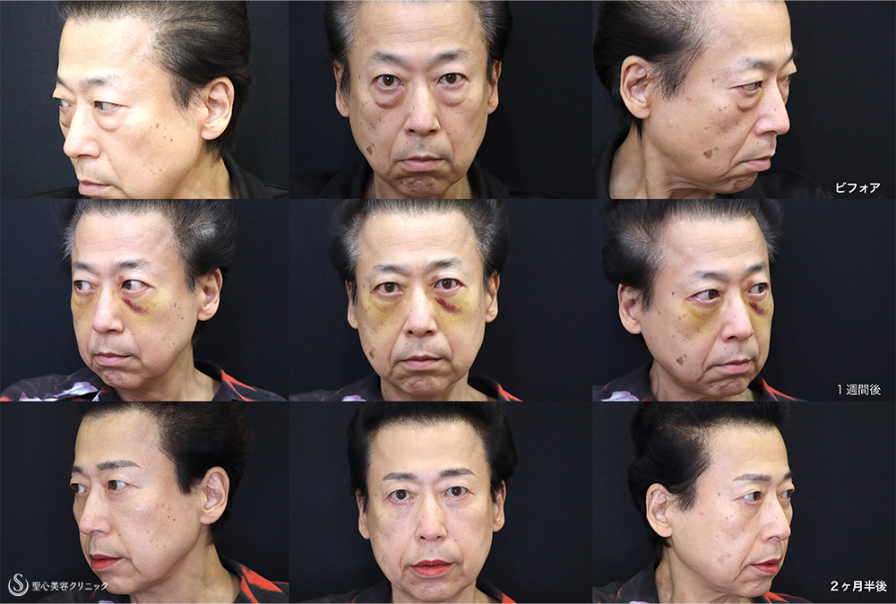 【60代男性・目の下のたるみ、ほうれい線】　目の下のたるみ取り＋プレミアムPRP皮膚再生療法（2か月半後） After 