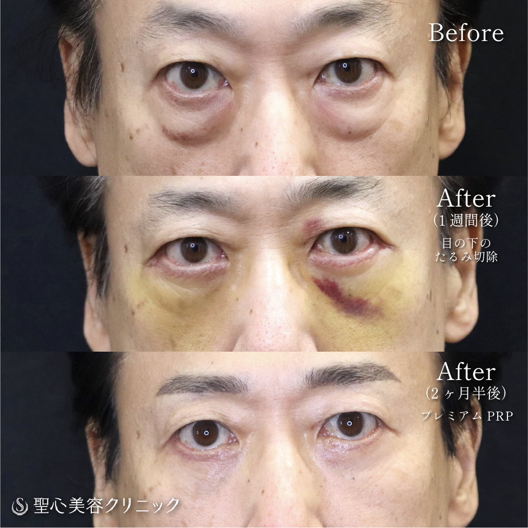 【60代男性・目の下のたるみ、ほうれい線】　目の下のたるみ取り＋プレミアムPRP皮膚再生療法（2か月半後） After 