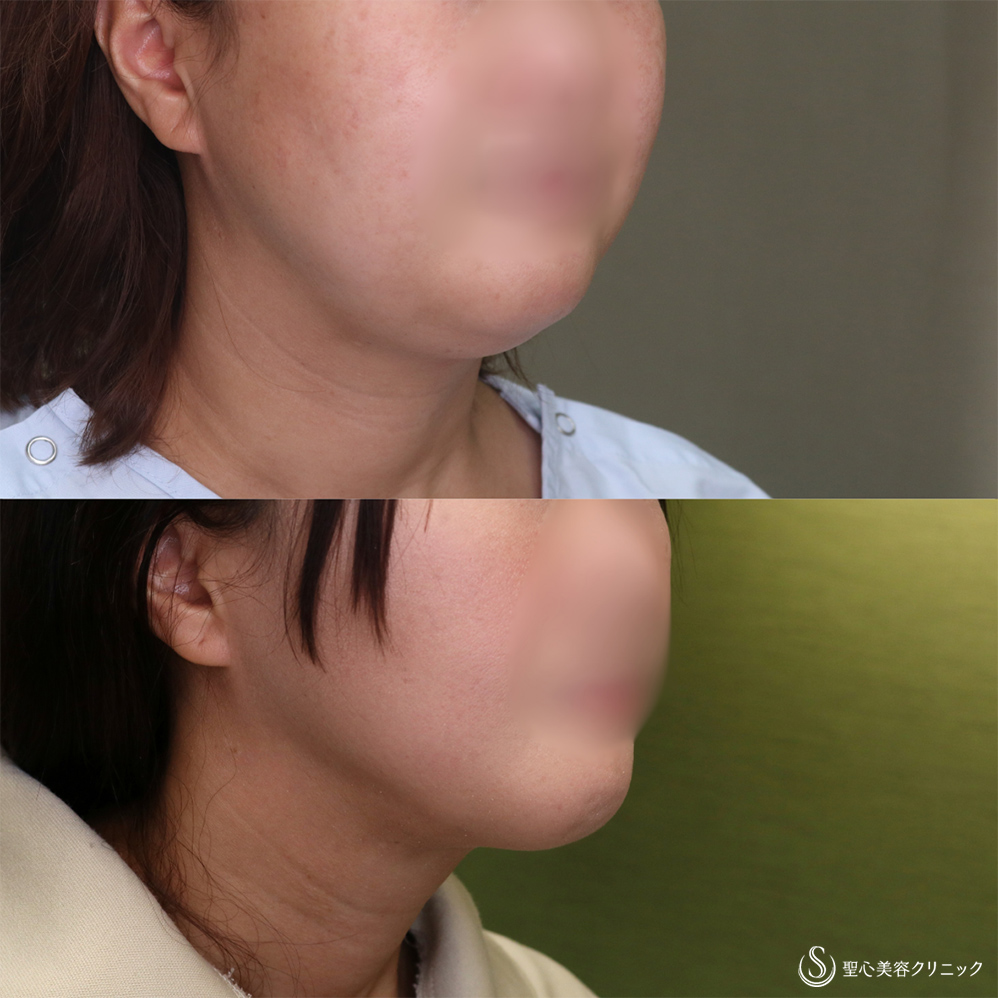 【40代女性・スッキリしたフェイスラインに】ベイザーリポ2.2脂肪吸引(頬・顎下)(3か月後) After 