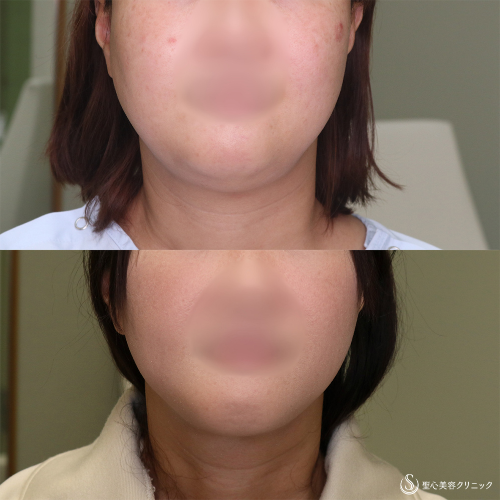 【40代女性・スッキリしたフェイスラインに】ベイザーリポ2.2脂肪吸引(頬・顎下)(3か月後) After 