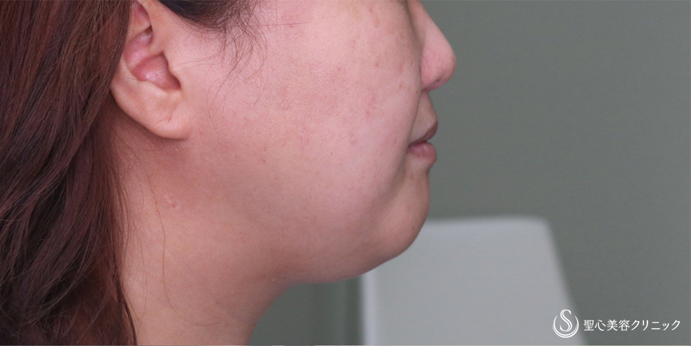 【40代女性・スッキリしたフェイスラインに】ベイザーリポ2.2脂肪吸引(頬・顎下)(3か月後) Before 