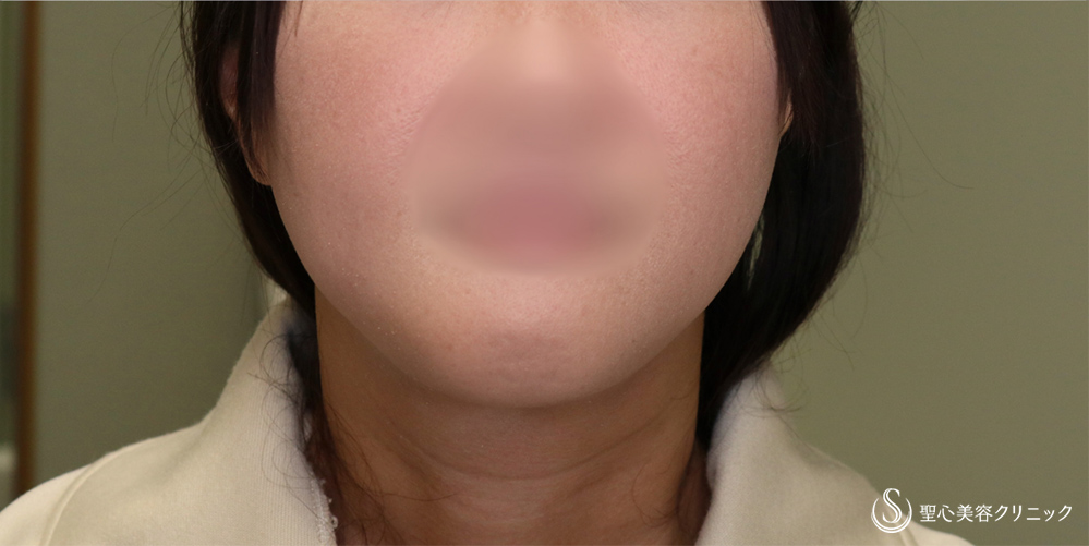 【40代女性・スッキリしたフェイスラインに】ベイザーリポ2.2脂肪吸引(頬・顎下)(3か月後) After 