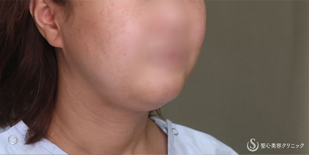 【40代女性・スッキリしたフェイスラインに】ベイザーリポ2.2脂肪吸引(頬・顎下)(3か月後) Before 