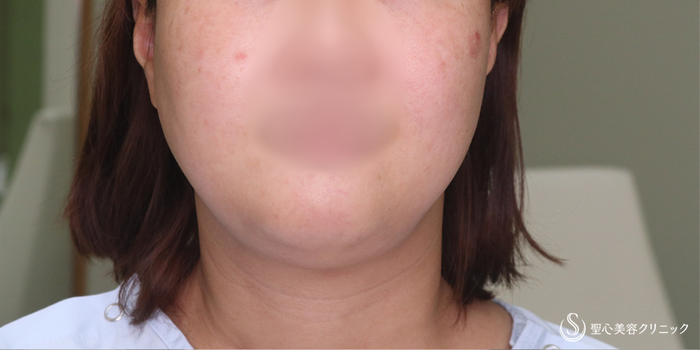 【40代女性・スッキリしたフェイスラインに】ベイザーリポ2.2脂肪吸引(頬・顎下)(3か月後) Before 