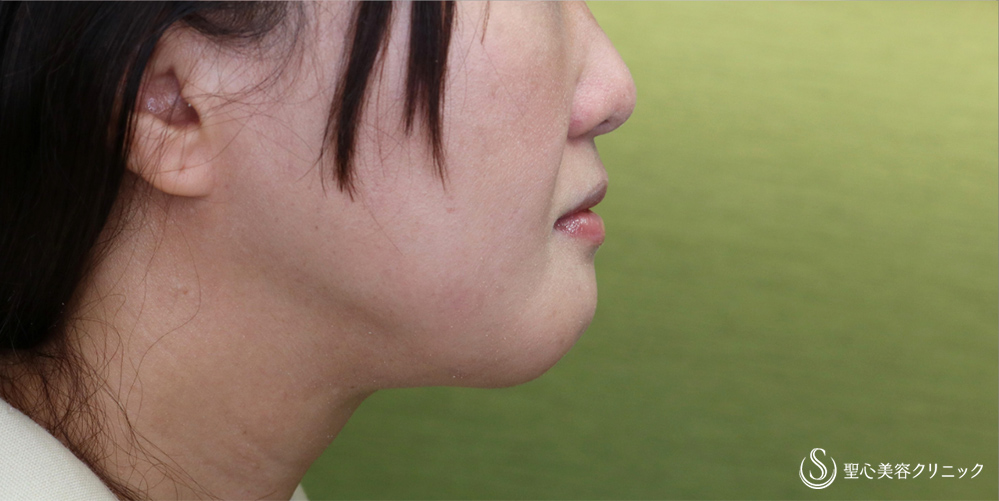 【40代女性・スッキリしたフェイスラインに】ベイザーリポ2.2脂肪吸引(頬・顎下)(3か月後) After 