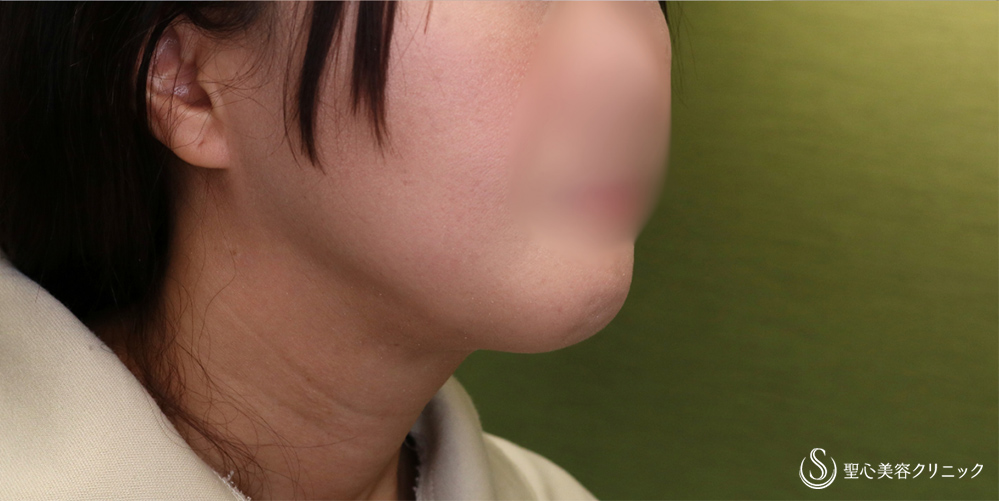 【40代女性・スッキリしたフェイスラインに】ベイザーリポ2.2脂肪吸引(頬・顎下)(3か月後) After 