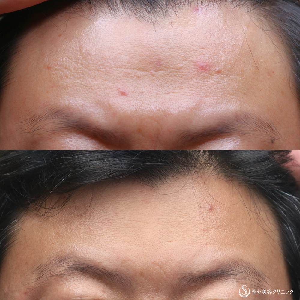 【40代男性・注入で額のシワ改善】プレミアムPRP皮膚再生療法(額)(2年後) After 