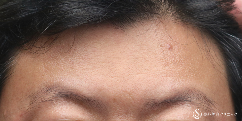 【40代男性・注入で額のシワ改善】プレミアムPRP皮膚再生療法(額)(2年後) After 