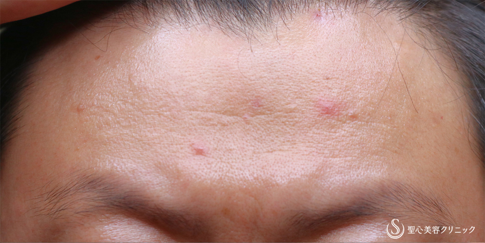 【40代男性・注入で額のシワ改善】プレミアムPRP皮膚再生療法(額)(2年後) Before 