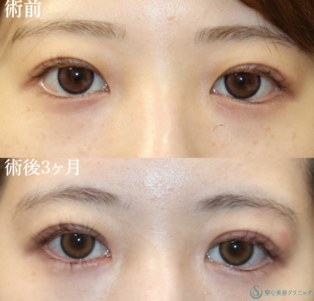 【20代女性・二重ラインを内側までしっかりと】目上切開(3ヶ月後) Before 