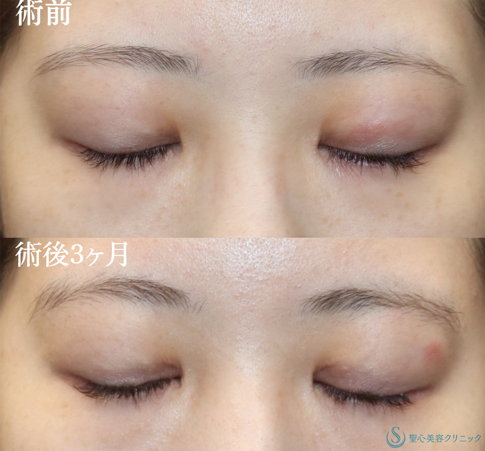 【20代女性・二重ラインを内側までしっかりと】目上切開(3ヶ月後) After 