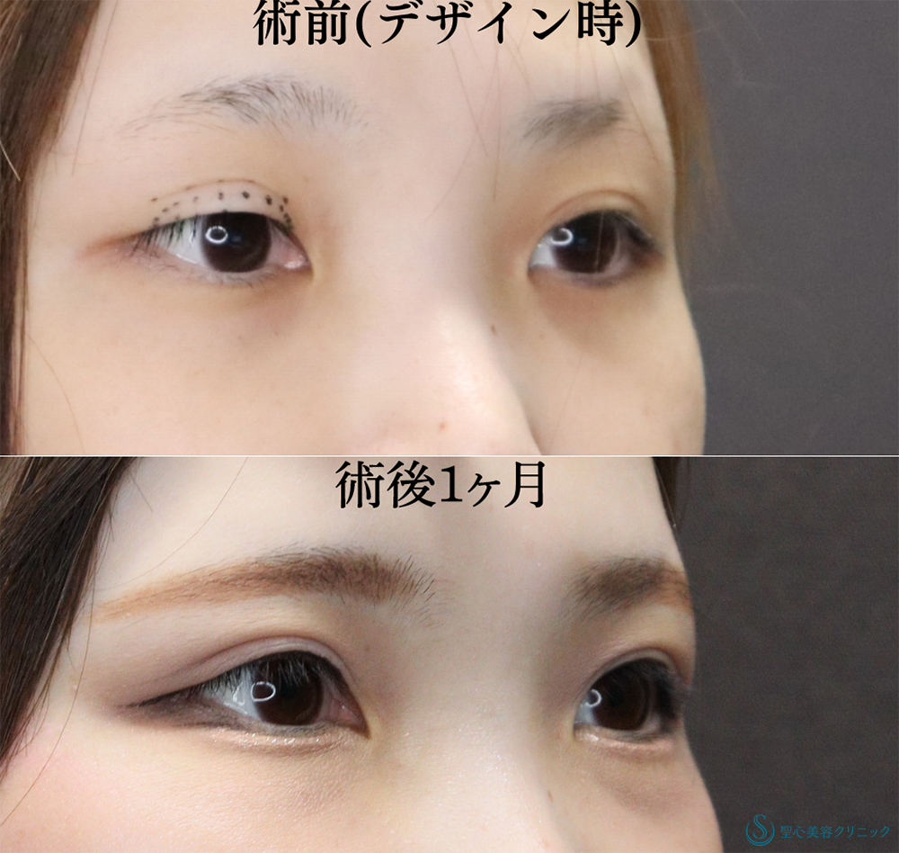 【20代女性・ハム目を改善！】睫毛上皮膚切除（ハム目修正）（右1ヶ月後） After 