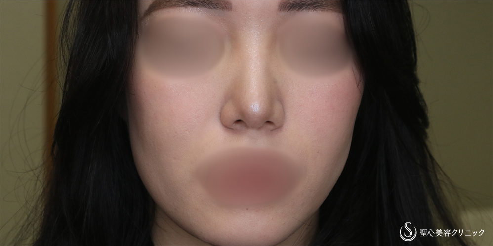 【20代女性・鼻先をスッキリ】鼻尖縮小＋鼻尖形成（耳介軟骨移植）(1ヶ月後) After 