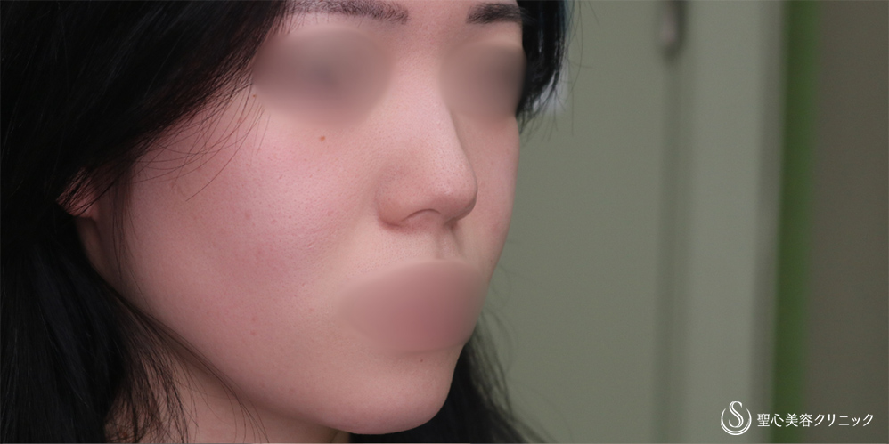 【20代女性・鼻先をスッキリ】鼻尖縮小＋鼻尖形成（耳介軟骨移植）(1ヶ月後) Before 