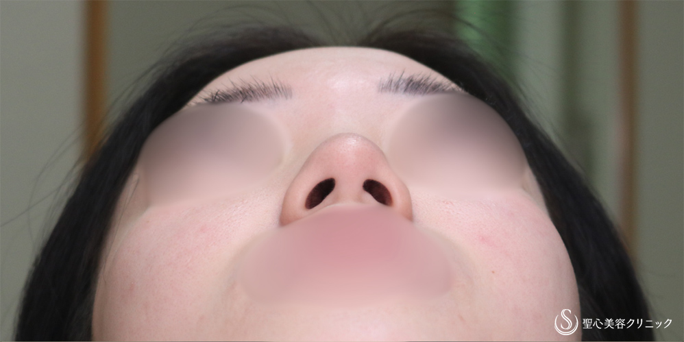 【20代女性・鼻先をスッキリ】鼻尖縮小＋鼻尖形成（耳介軟骨移植）(1ヶ月後) Before 