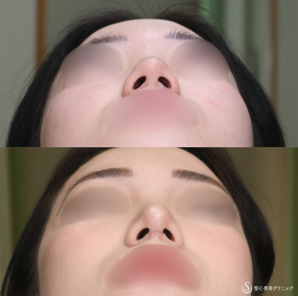 【20代女性・鼻先をスッキリ】鼻尖縮小＋鼻尖形成（耳介軟骨移植）(1ヶ月後) After 