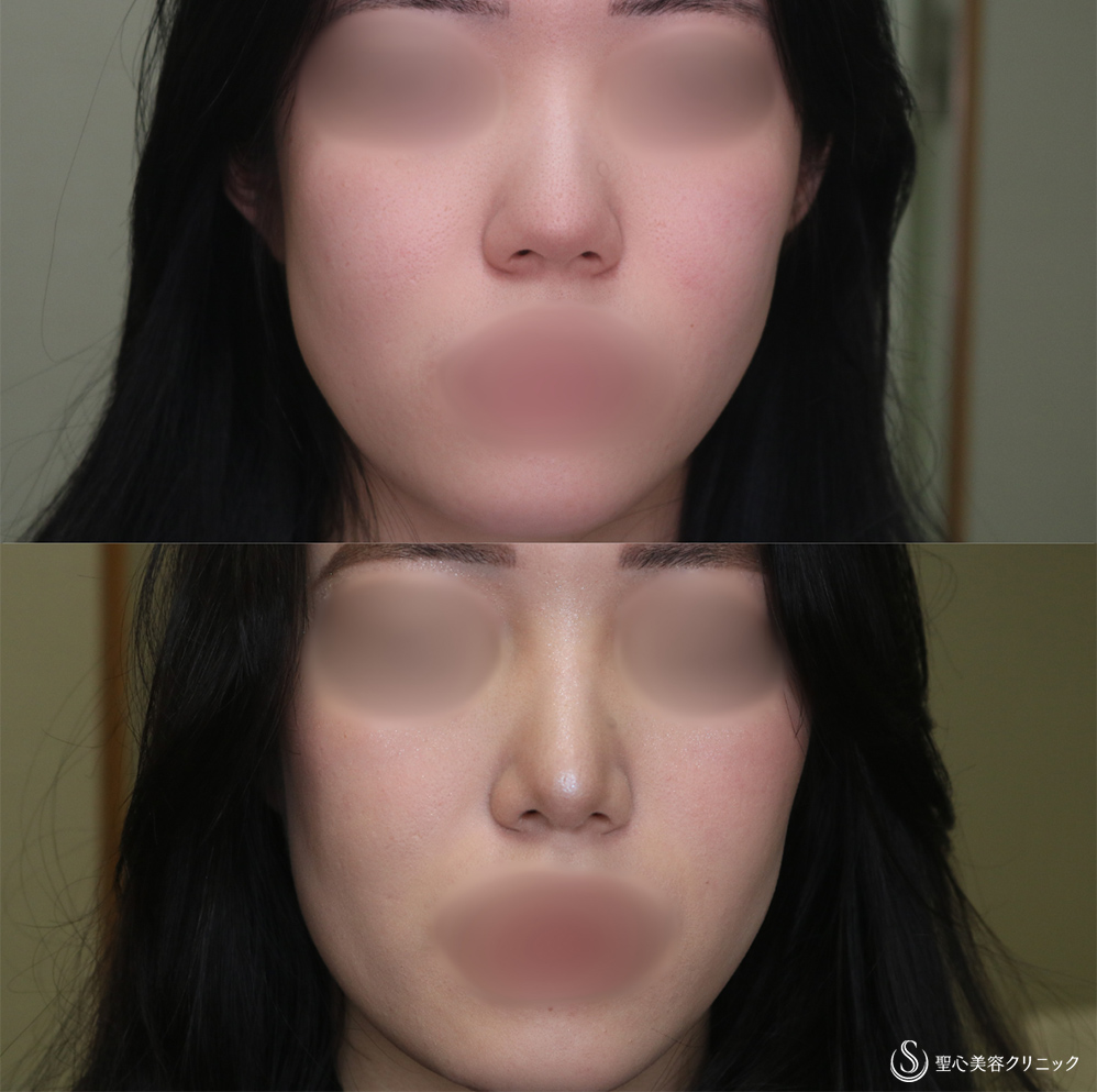 【20代女性・鼻先をスッキリ】鼻尖縮小＋鼻尖形成（耳介軟骨移植）(1ヶ月後) After 