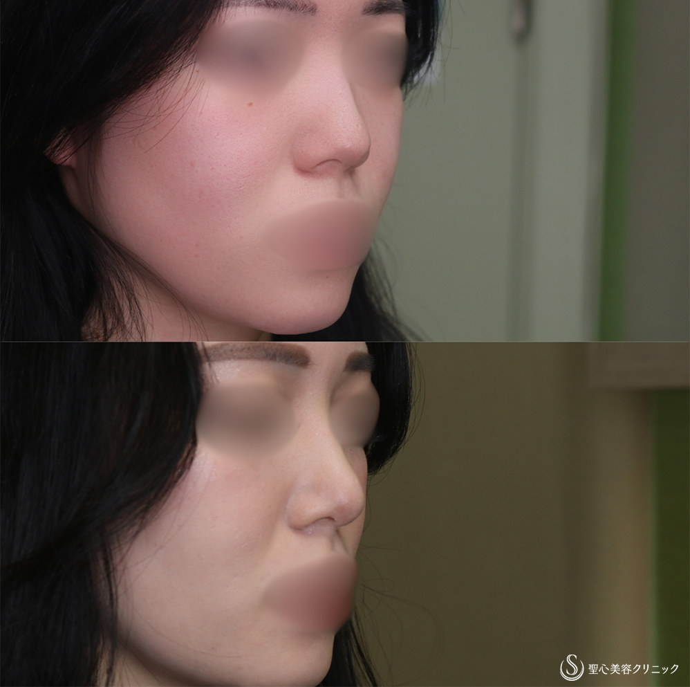 【20代女性・鼻先をスッキリ】鼻尖縮小＋鼻尖形成（耳介軟骨移植）(1ヶ月後) After 