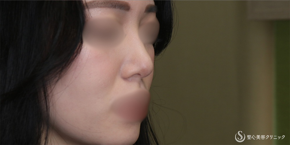 【20代女性・鼻先をスッキリ】鼻尖縮小＋鼻尖形成（耳介軟骨移植）(1ヶ月後) After 