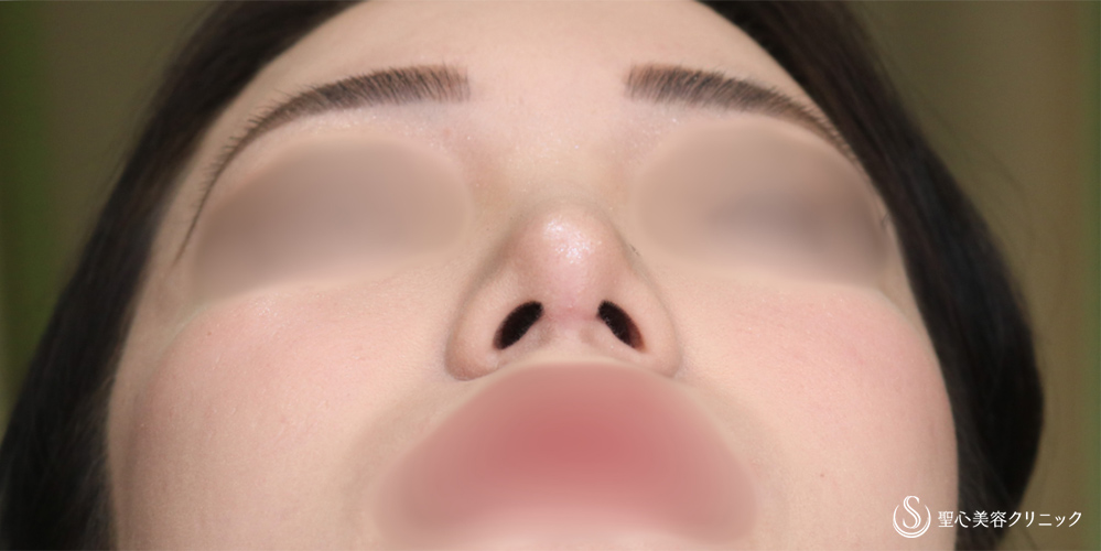 【20代女性・鼻先をスッキリ】鼻尖縮小＋鼻尖形成（耳介軟骨移植）(1ヶ月後) After 