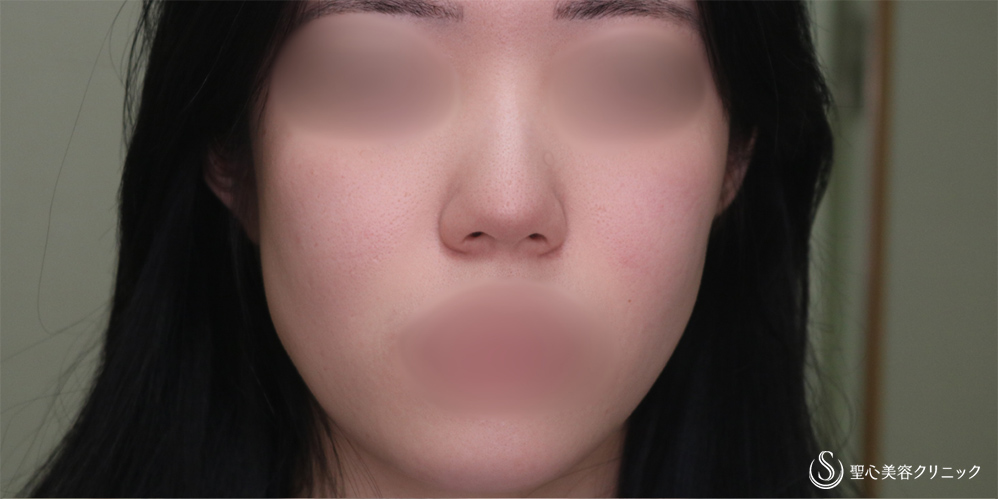 【20代女性・鼻先をスッキリ】鼻尖縮小＋鼻尖形成（耳介軟骨移植）(1ヶ月後) Before 