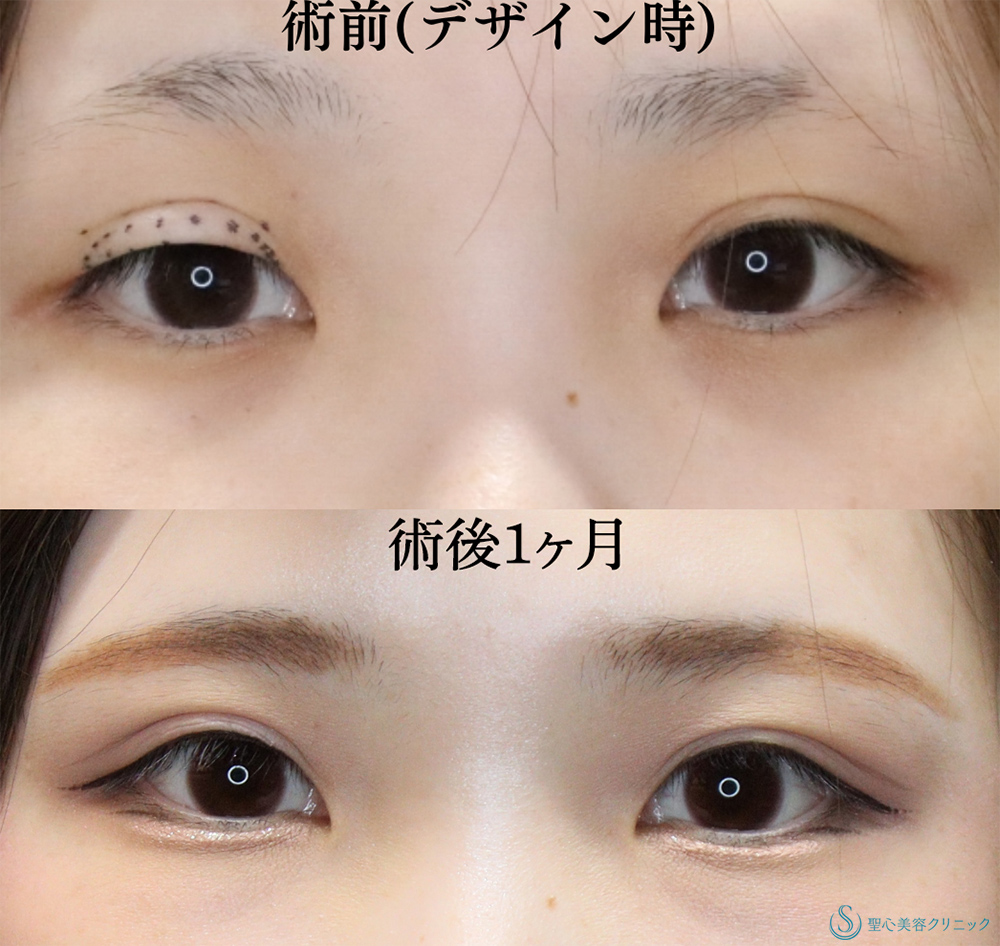 【20代女性・ハム目を改善！】睫毛上皮膚切除（ハム目修正）（右1ヶ月後） Before 