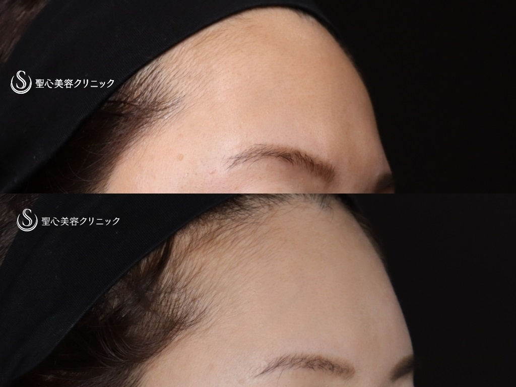 【40代女性・額と眉間の凹みが気になる】プレミアムPRP皮膚再生療法（額、眉間）（7ヶ月後） After 
