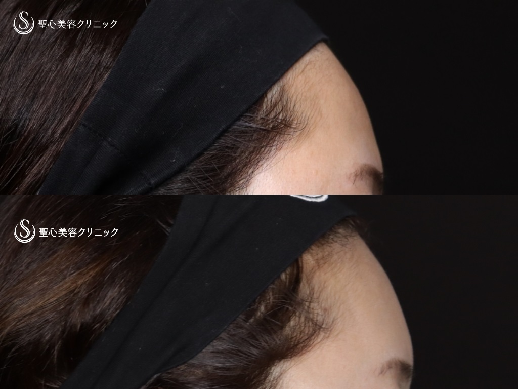 【40代女性・額と眉間の凹みが気になる】プレミアムPRP皮膚再生療法（額、眉間）（7ヶ月後） After 