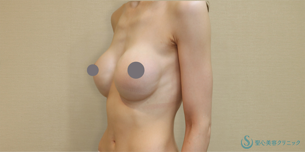 【30代女性・下垂も解消し理想のバストへ】バックプロテーゼ入れ替え(モティバ・エルゴノミクス DEMI450cc・425cc)(1ヶ月後) Before 