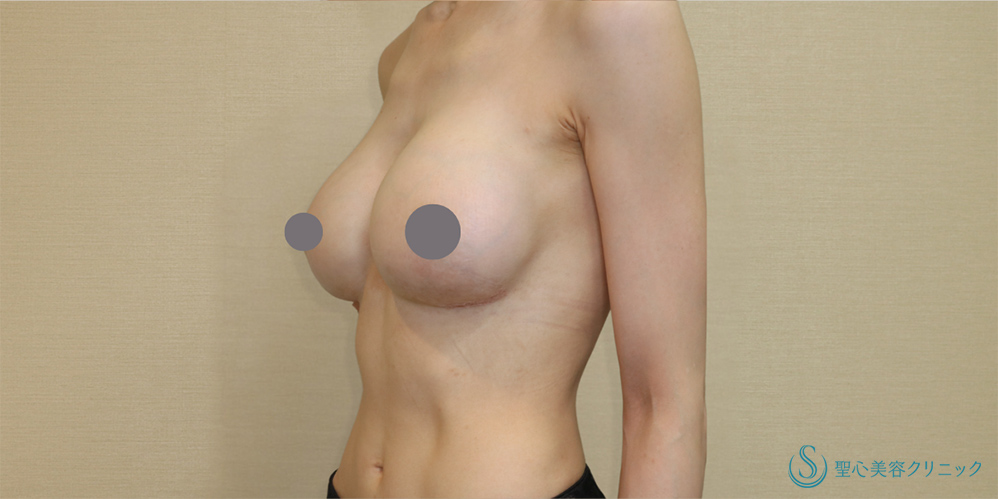【30代女性・下垂も解消し理想のバストへ】バックプロテーゼ入れ替え(モティバ・エルゴノミクス DEMI450cc・425cc)(1ヶ月後) After 