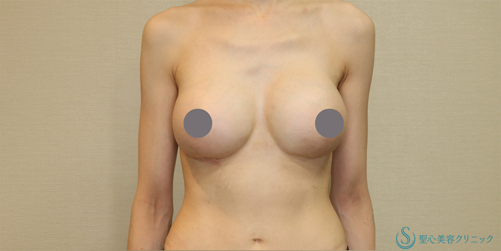【30代女性・下垂も解消し理想のバストへ】バックプロテーゼ入れ替え(モティバ・エルゴノミクス DEMI450cc・425cc)(1ヶ月後) After 