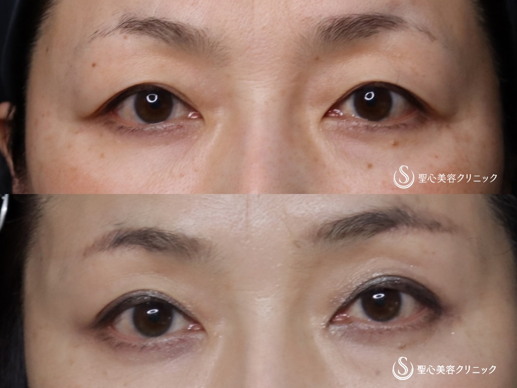【50代女性・奥二重から自然な二重に】眉下切開法（眉下リフト）（6ヶ月後） After 