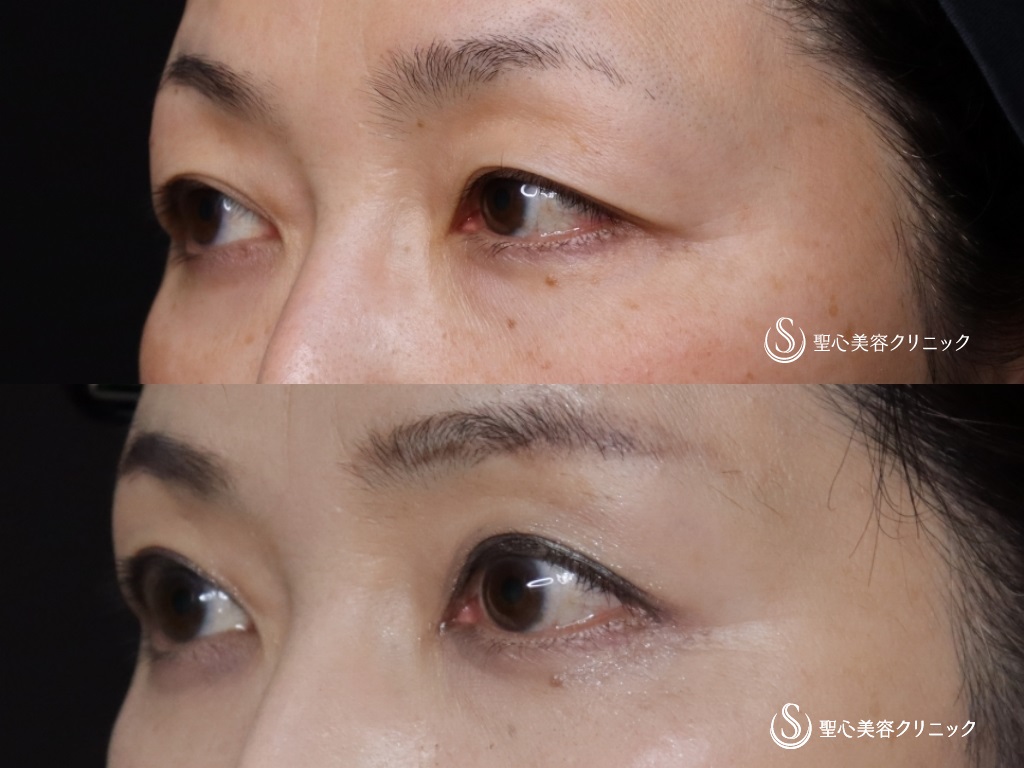 【50代女性・奥二重から自然な二重に】眉下切開法（眉下リフト）（6ヶ月後） After 