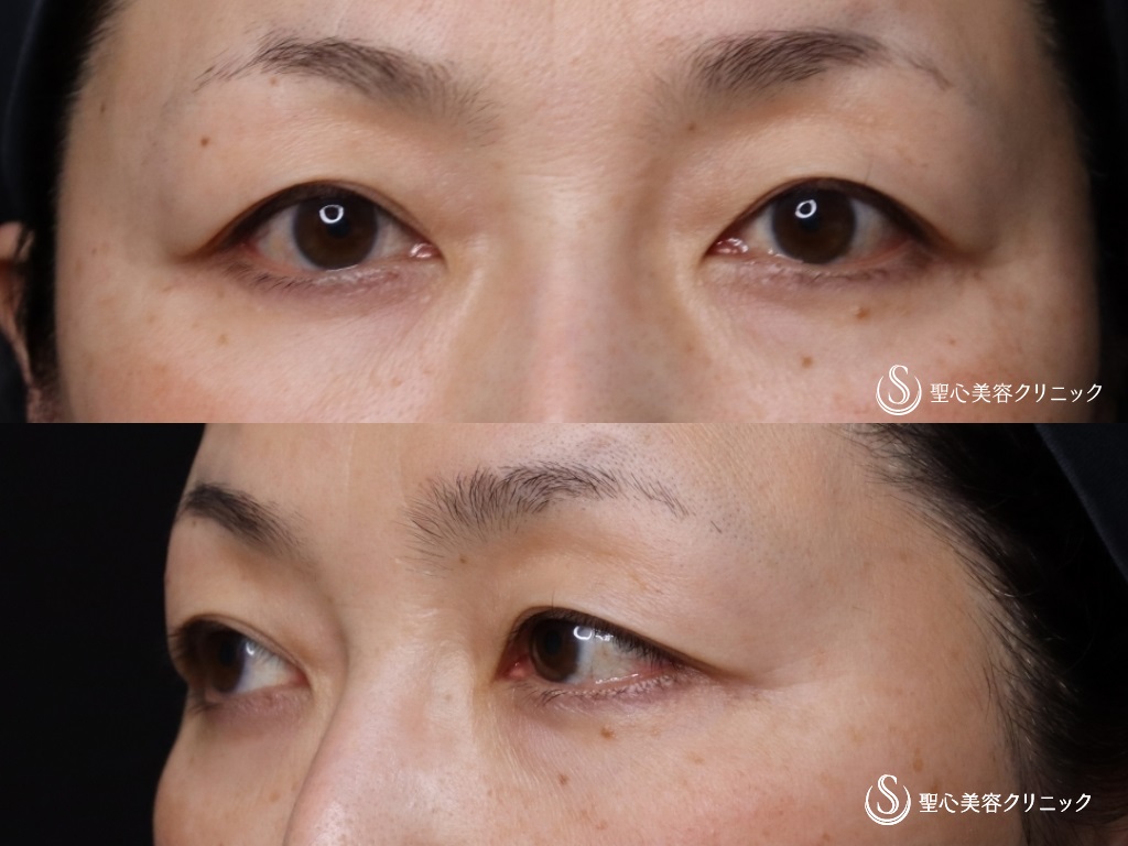 【50代女性・奥二重から自然な二重に】眉下切開法（眉下リフト）（6ヶ月後） Before 