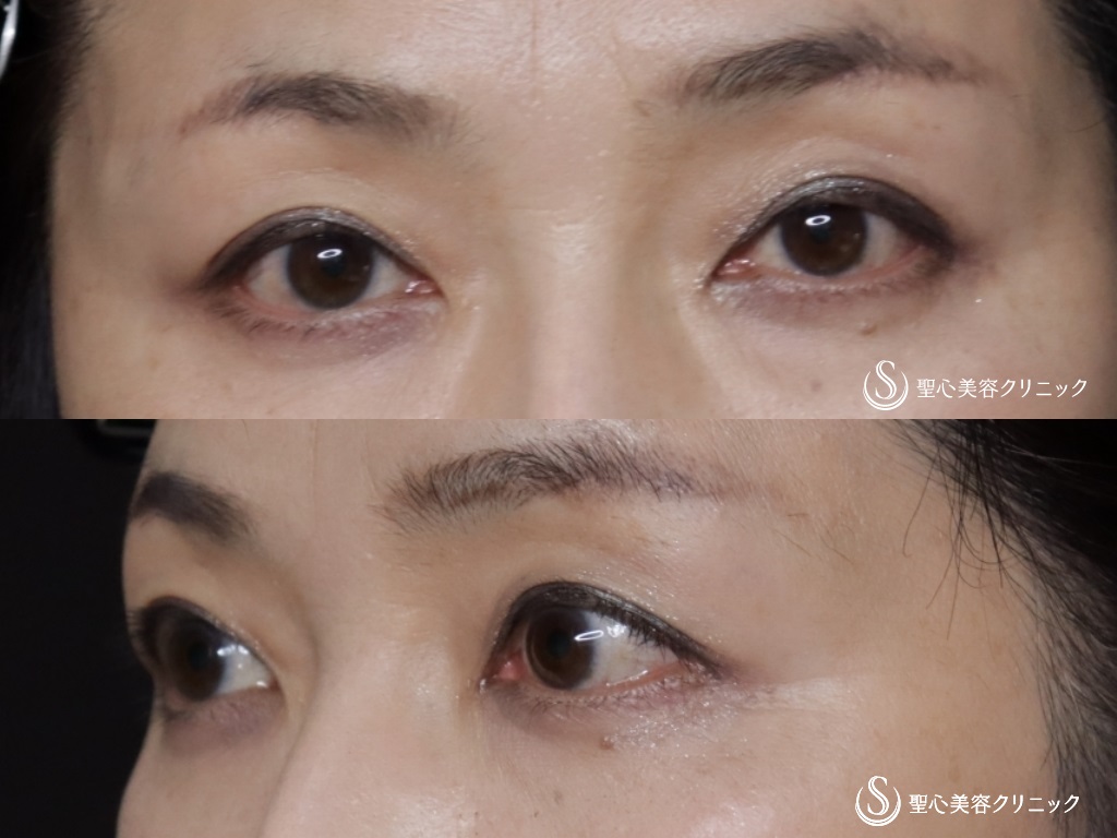 【50代女性・奥二重から自然な二重に】眉下切開法（眉下リフト）（6ヶ月後） After 