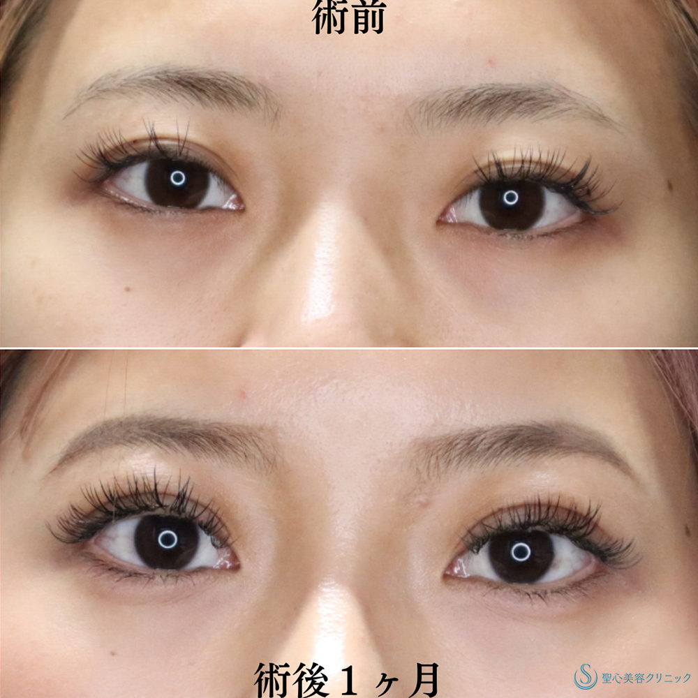 【20代女性・埋没法で綺麗目に】マイクロメソッド＋α（二重埋没法）（1ヶ月後） Before 