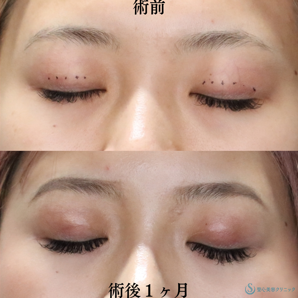 【20代女性・埋没法で綺麗目に】マイクロメソッド＋α（二重埋没法）（1ヶ月後） After 