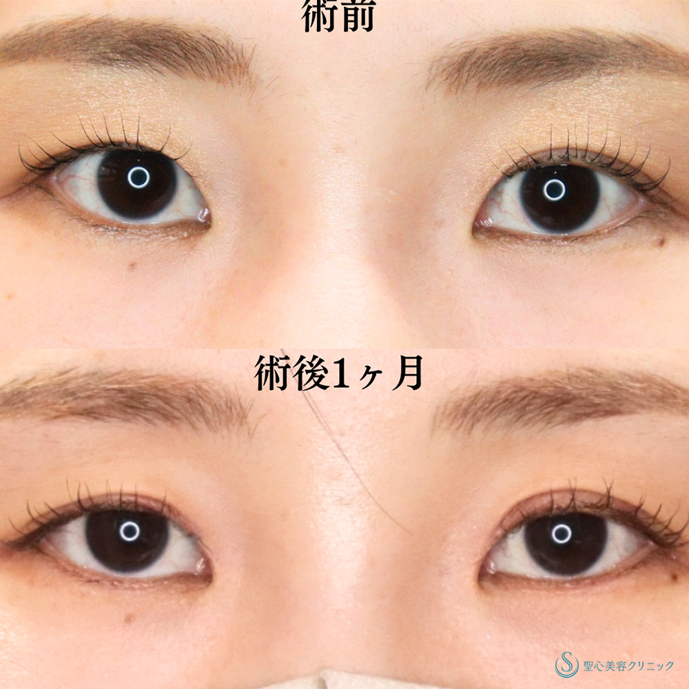 【30代女性・内側まで二重でクッキリ美人顔へ】目上切開（1ヶ月後） Before 