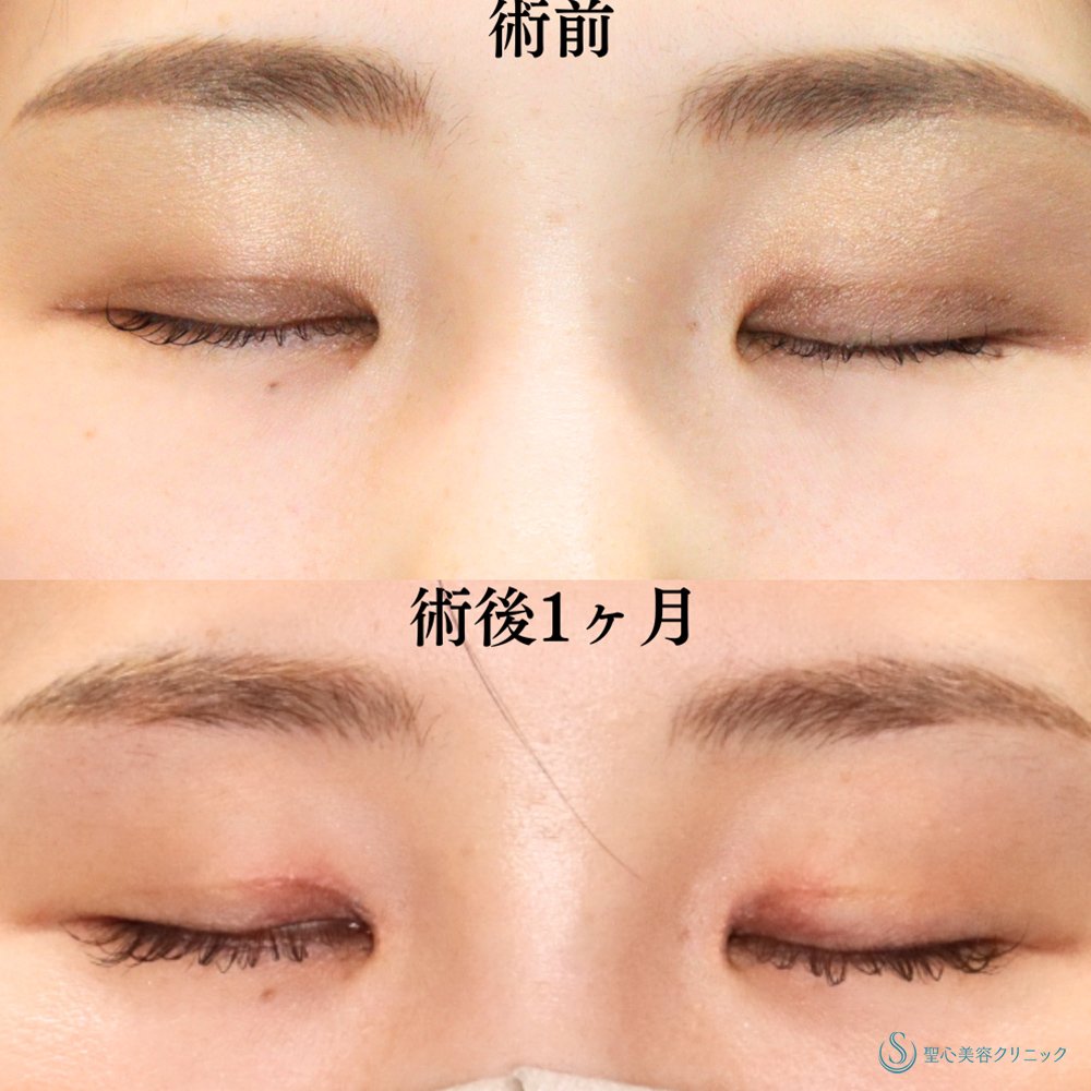 【30代女性・内側まで二重でクッキリ美人顔へ】目上切開（1ヶ月後） After 