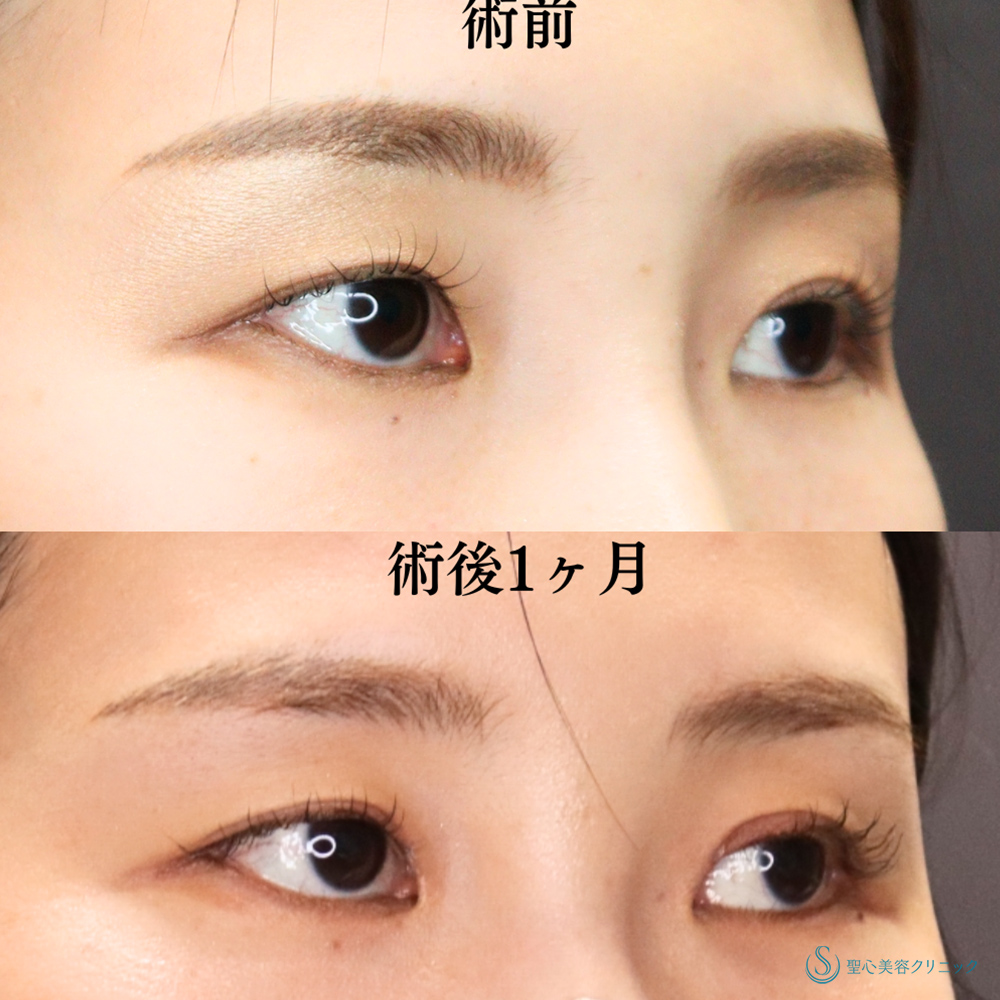【30代女性・内側まで二重でクッキリ美人顔へ】目上切開（1ヶ月後） After 