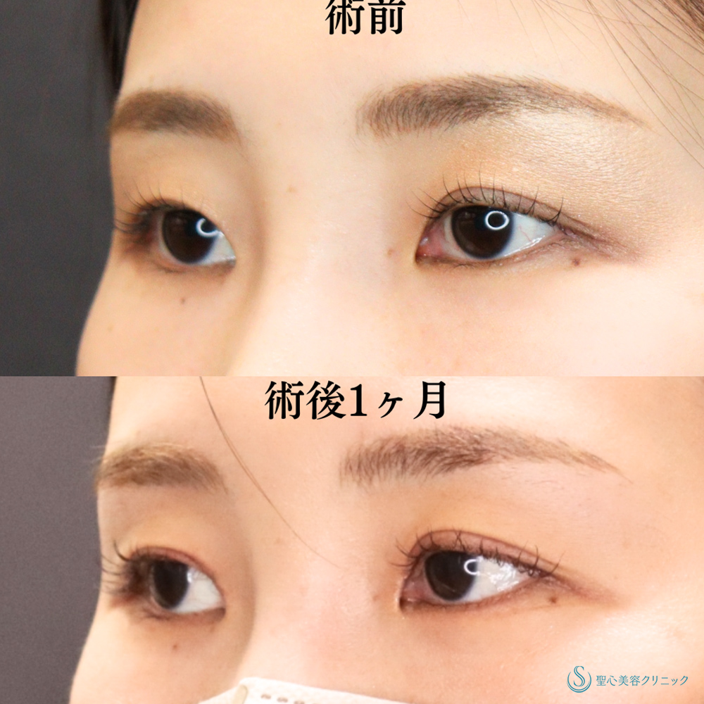 【30代女性・内側まで二重でクッキリ美人顔へ】目上切開（1ヶ月後） After 