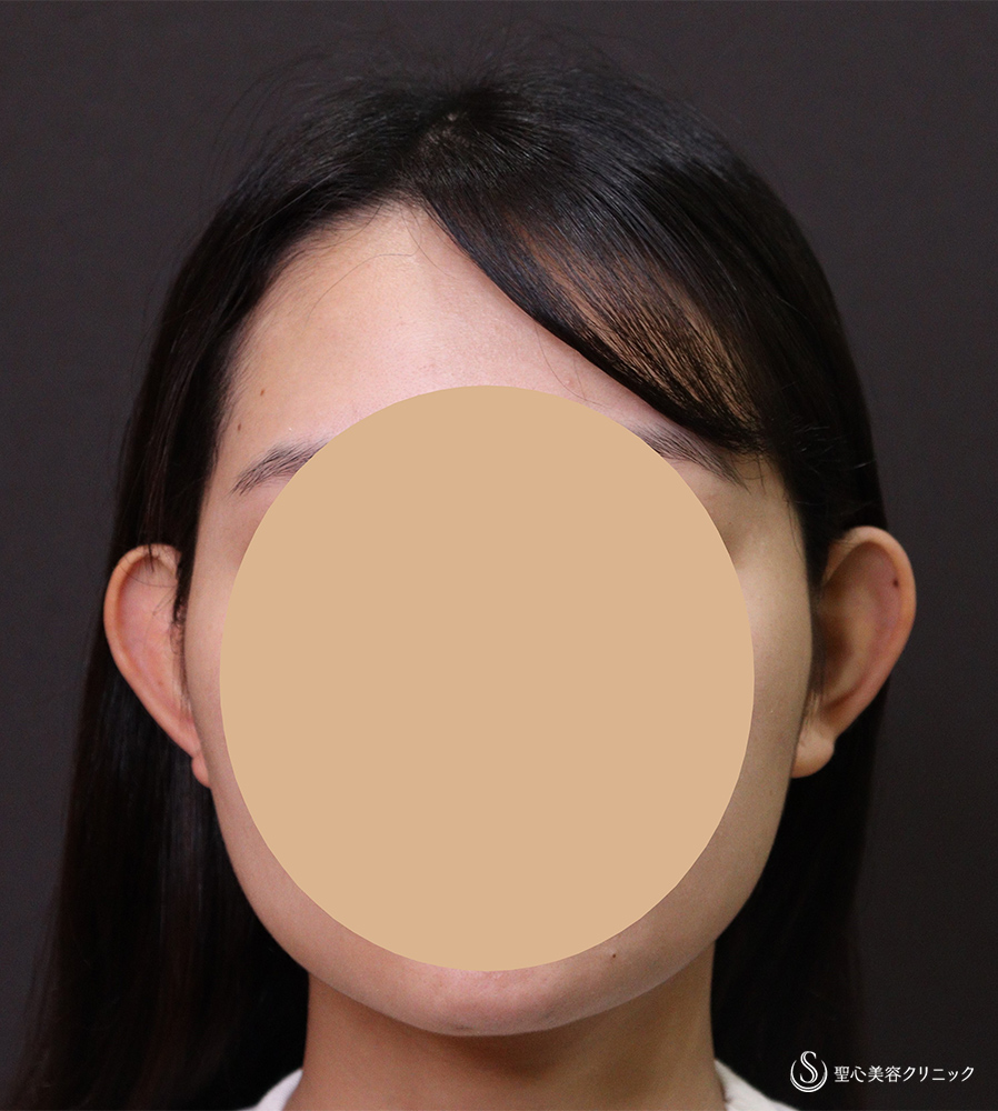 【20代女性・立ち耳】立ち耳修正（埋没法）（3ヶ月後） Before 